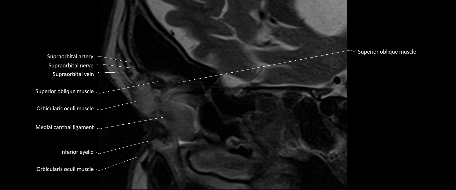 MRI Orbit sagittal cross sectional anatomy 3T image 2.webp